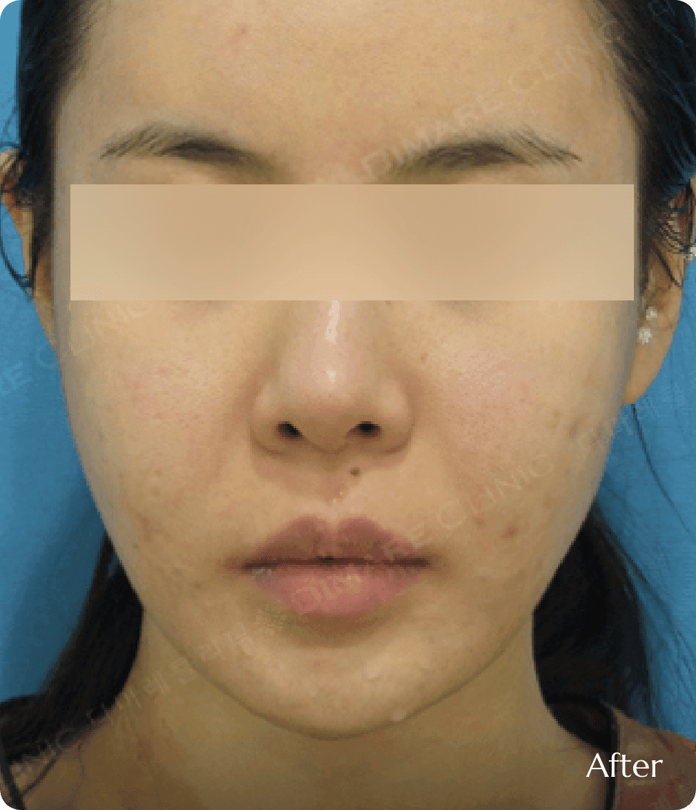 디마레클리닉 얼굴지방흡입 시술 후, 불필요한 지방 제거로 턱선이 드러나고 매끄럽고 갸름해진 V라인 변화 결과