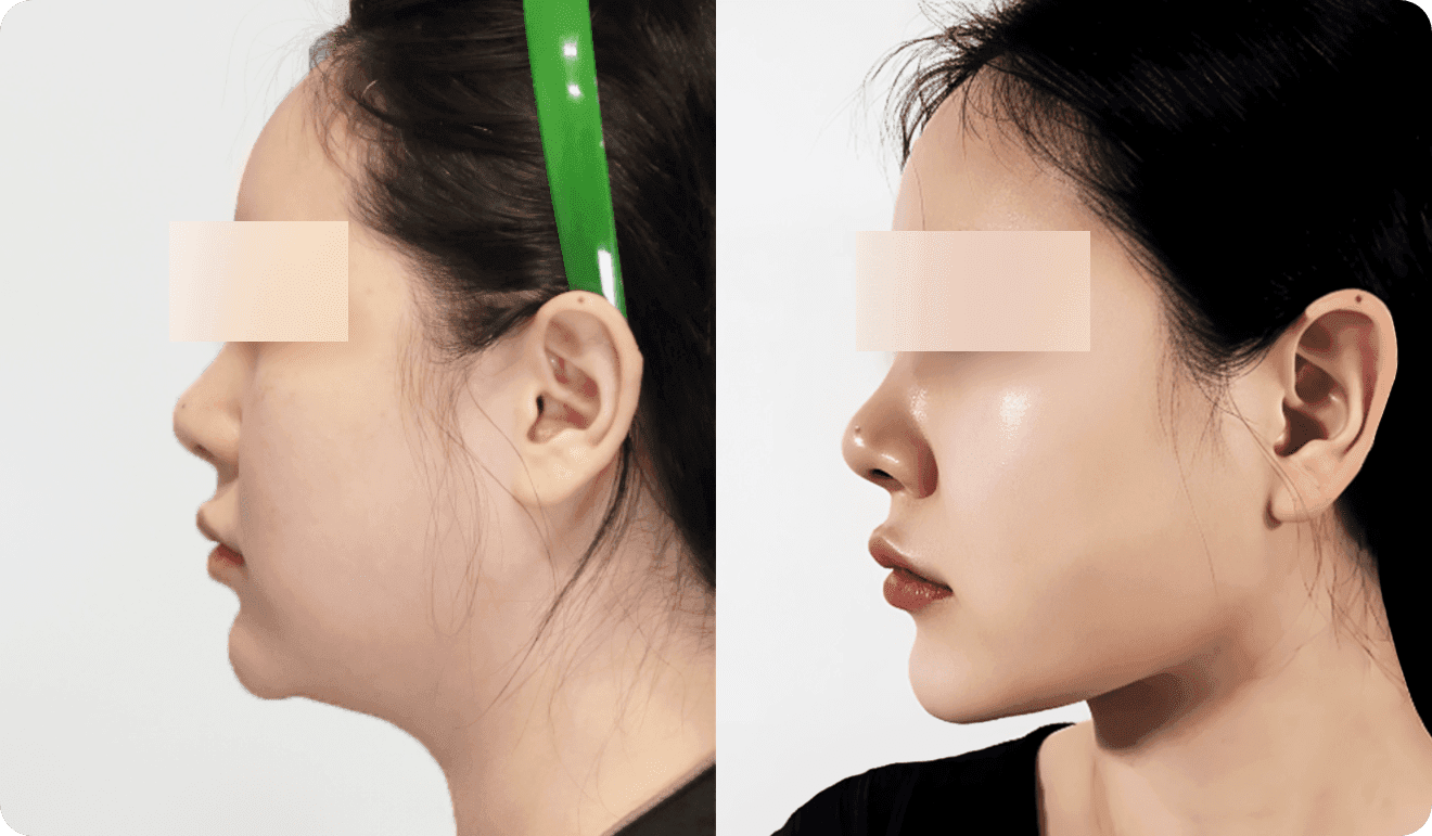 디마레클리닉 얼굴지방흡입 전후, 둔탁했던 턱 라인의 지방이 정리되어 매끄럽고 날렵한 V라인으로 변화된 정면 모습