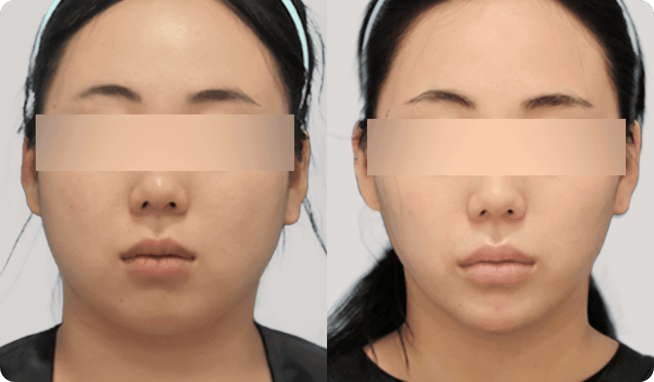 광대 지방흡입 전후, 도드라진 옆광대와 앞광대 지방을 줄여 얼굴 가로 폭이 좁아지고 윤곽이 부드러워진 수술 결과
